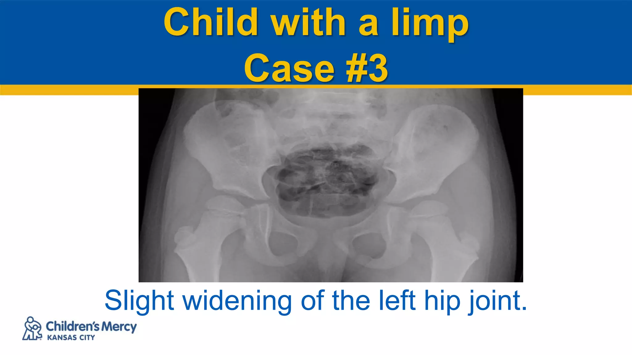 Child with a limp
Case #3
Slight widening of the left hip joint.
 