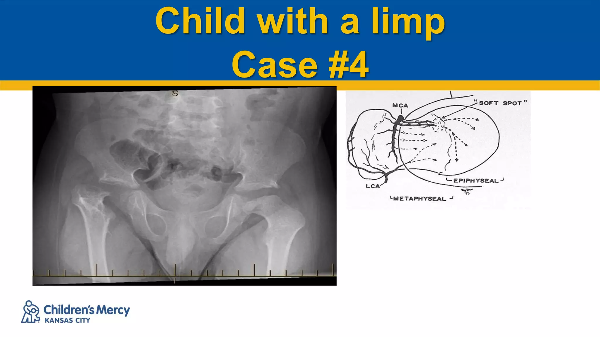 Child with a limp
Case #4
 