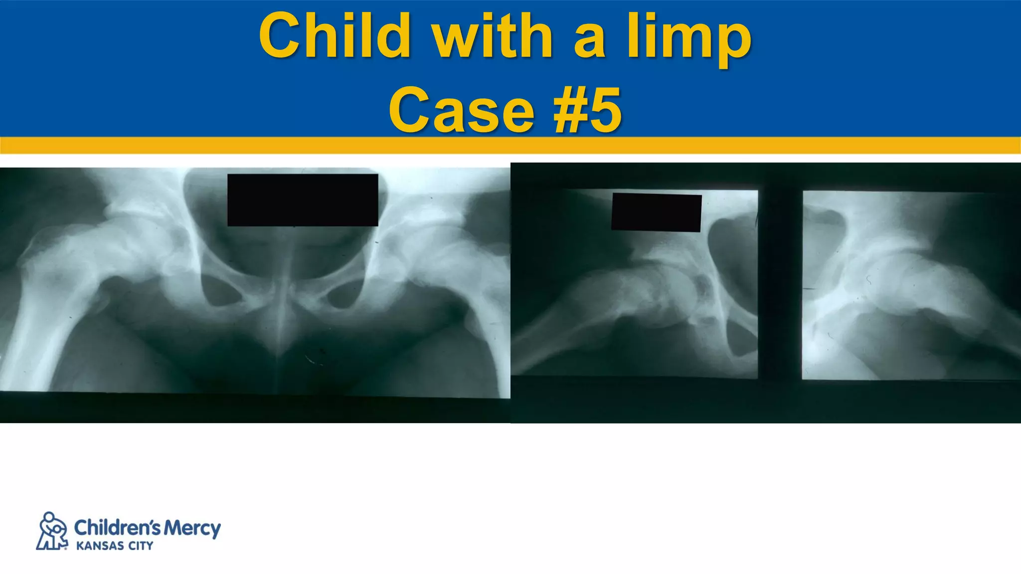 Child with a limp
Case #5
 