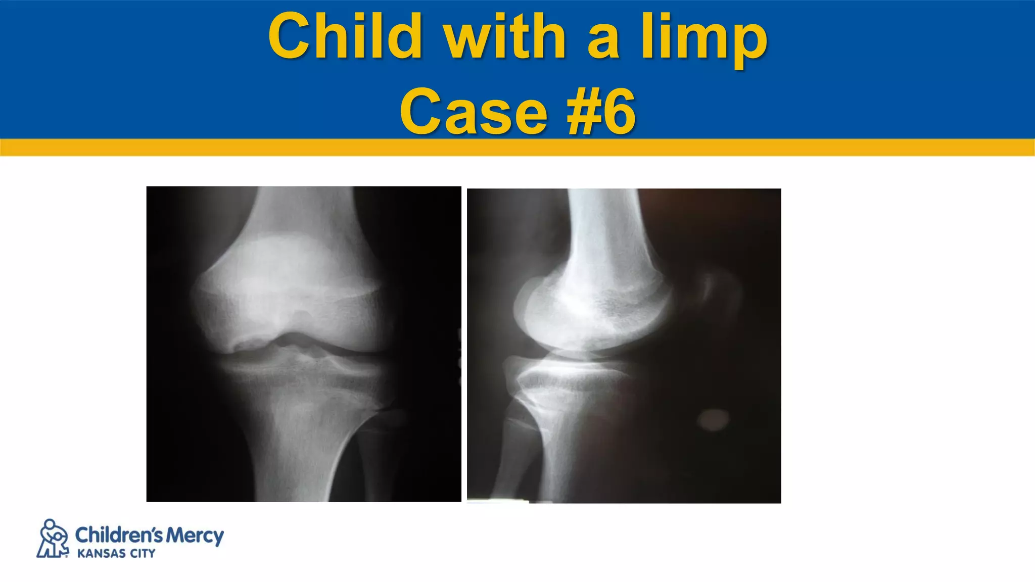 Child with a limp
Case #6
 