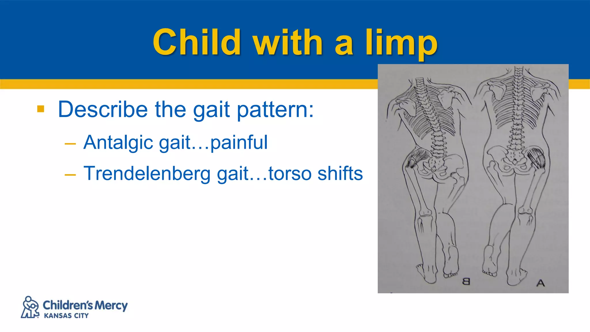 Child with a limp
 Describe the gait pattern:
– Antalgic gait…painful
– Trendelenberg gait…torso shifts
 