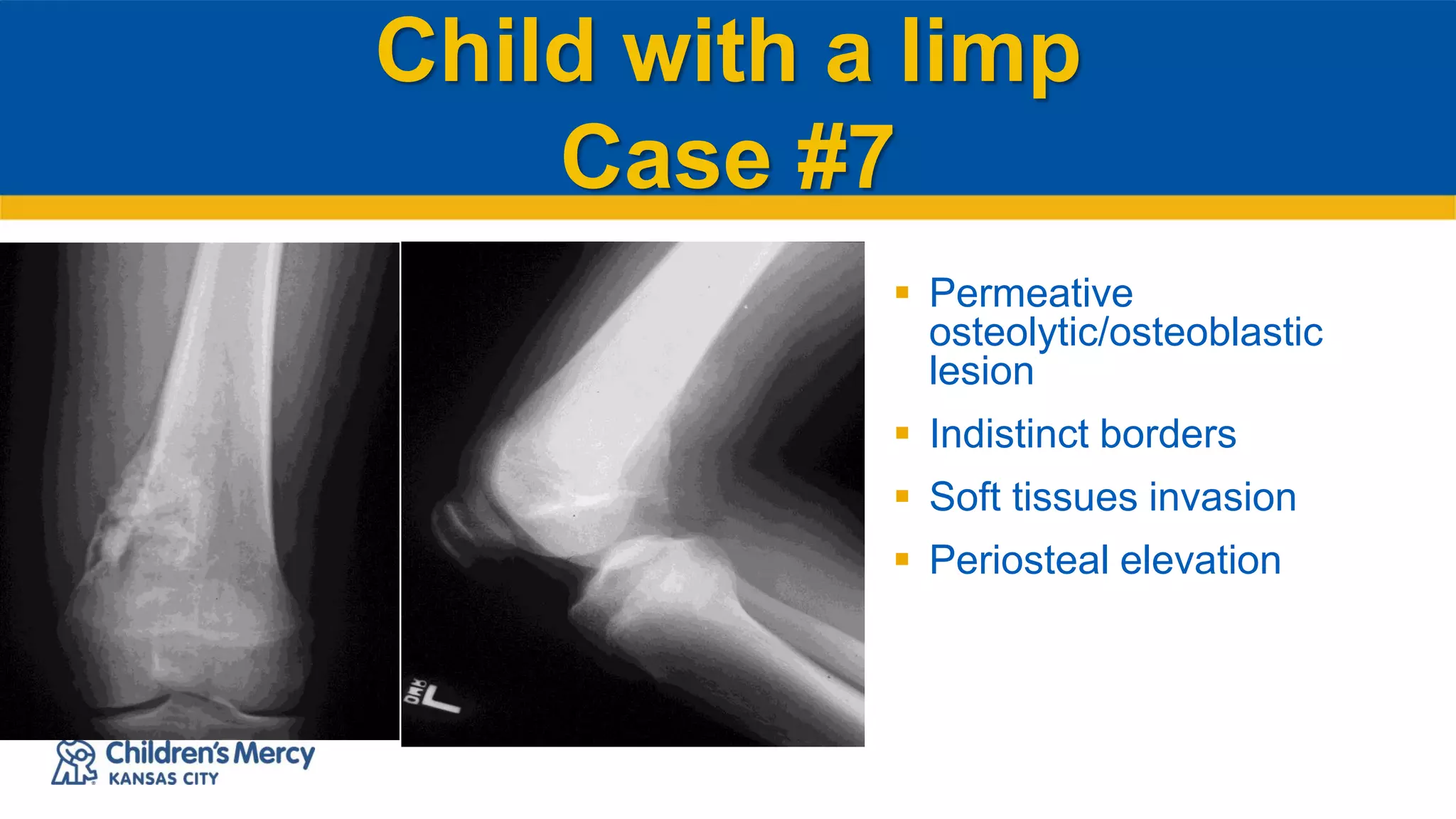 Child with a limp
Case #7
 Permeative
osteolytic/osteoblastic
lesion
 Indistinct borders
 Soft tissues invasion
 Periosteal elevation
 