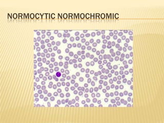 NORMOCYTIC NORMOCHROMIC
 