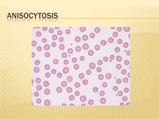 ANISOCYTOSIS
 