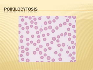 POIKILOCYTOSIS
 
