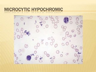MICROCYTIC HYPOCHROMIC
 