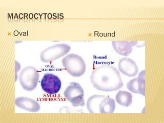 MACROCYTOSIS
 Oval  Round
 