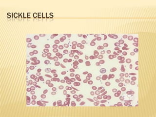 SICKLE CELLS
 