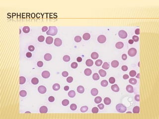 SPHEROCYTES
 