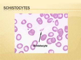 SCHISTOCYTES
 