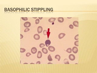 BASOPHILIC STIPPLING
 