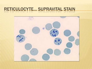 RETICULOCYTE… SUPRAVITAL STAIN
 