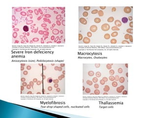 Severe Iron defeciency                              Macrocytosis
anemia                                              Macrocytes, Ovalocytes
Anisocytosis (size), Poikilocytosis (shape)




                       Myelofibrosis                               Thallassemia
                       Tear drop shaped cells, nucleated cells     Target cells
 