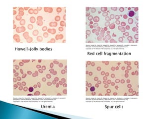 Howell-Jolly bodies
                      Red cell fragmentation




             Uremia           Spur cells
 