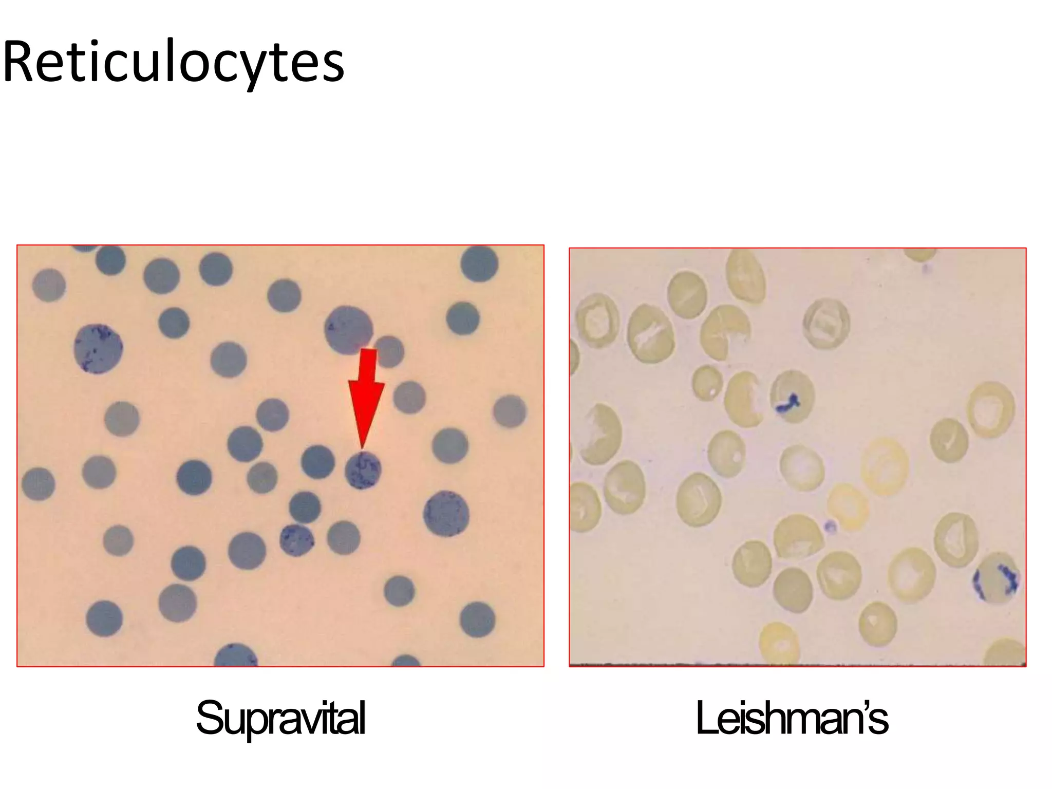 Reticulocytes
Leishman’s
Supravital
 
