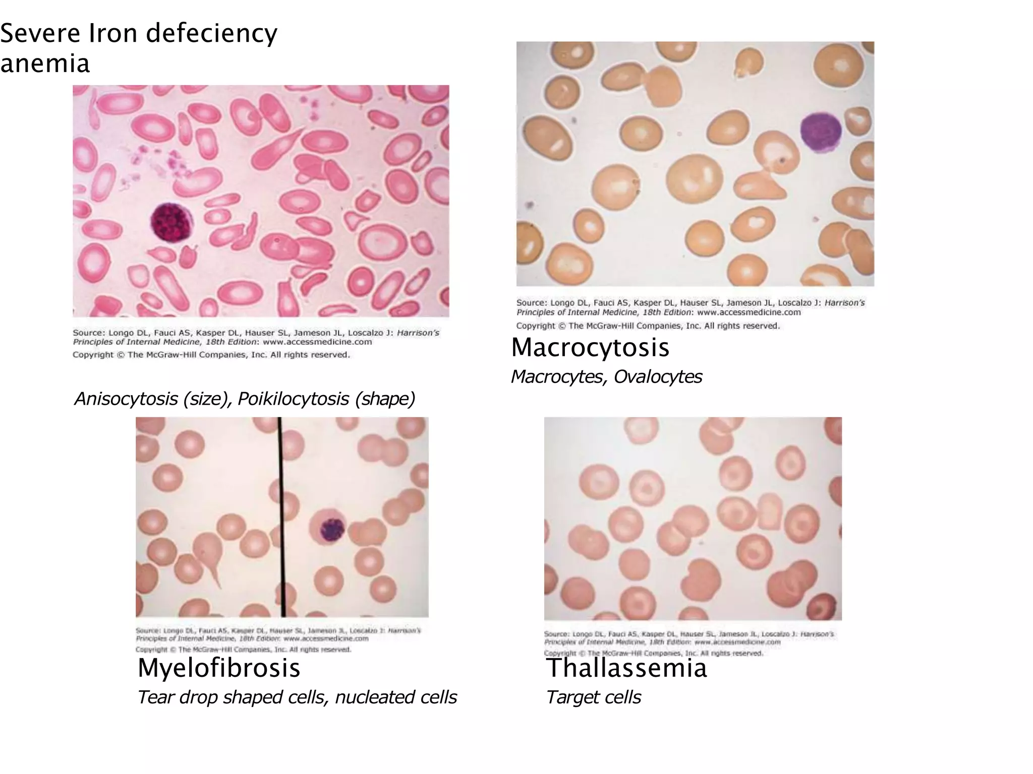 Severe Iron defeciency
anemia
Anisocytosis (size), Poikilocytosis (shape)
Macrocytosis
Macrocytes, Ovalocytes
Myelofibrosis
Tear drop shaped cells, nucleated cells
Thallassemia
Target cells
 