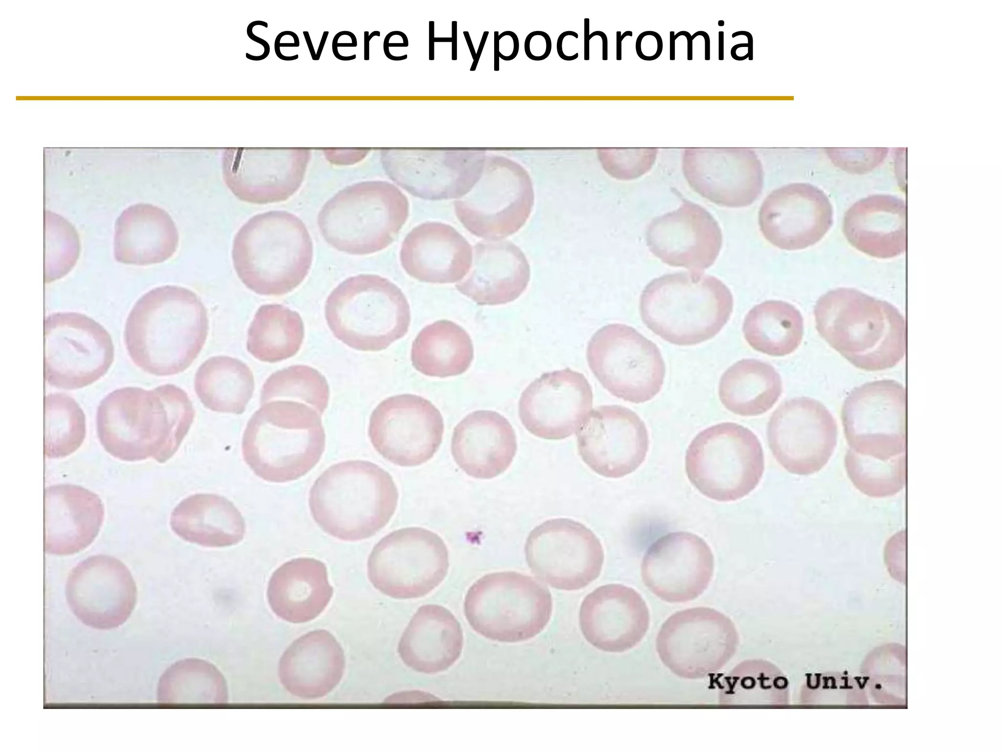 Severe Hypochromia
 