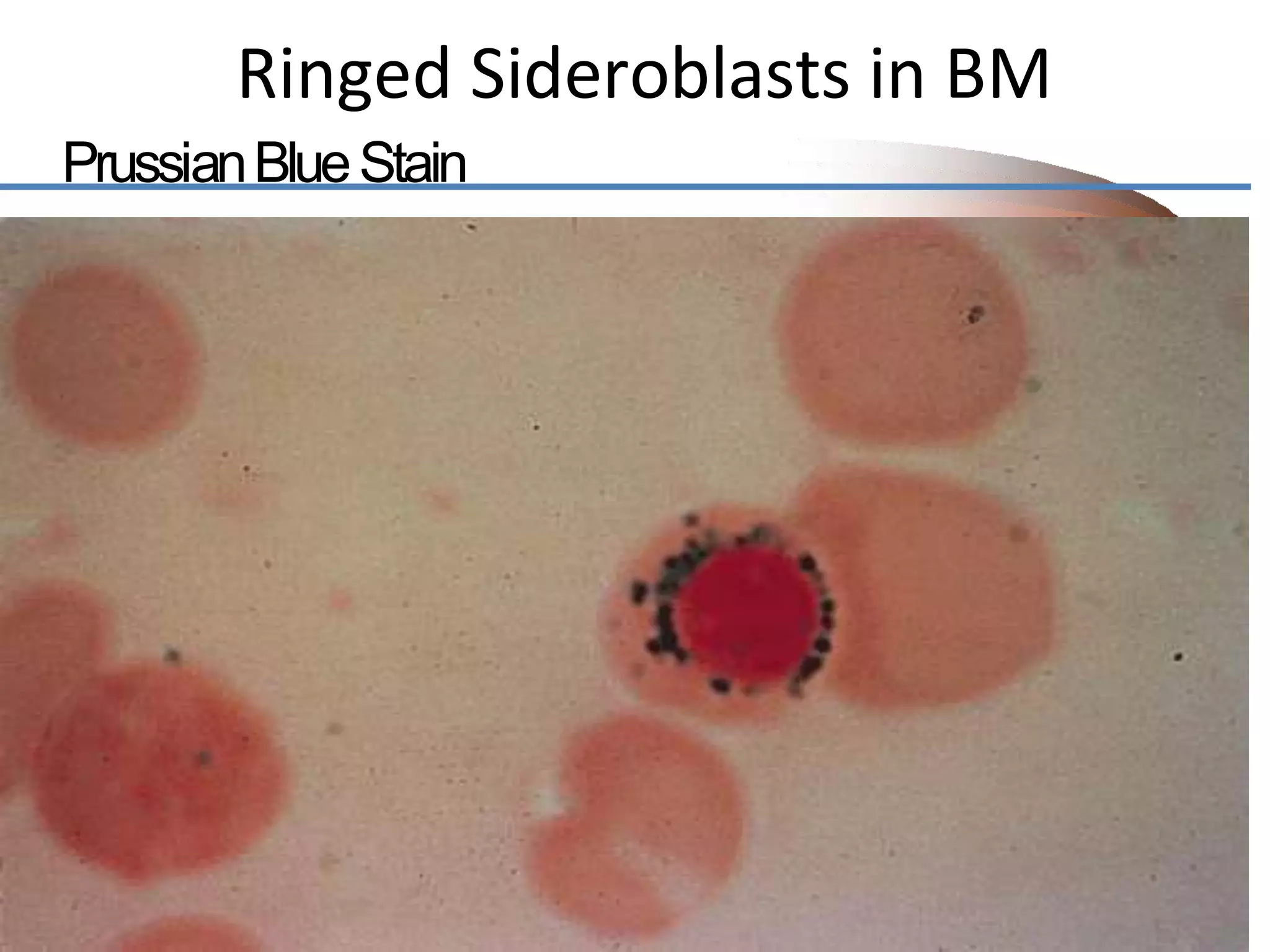 Ringed Sideroblasts in BM
PrussianBlueStain
 