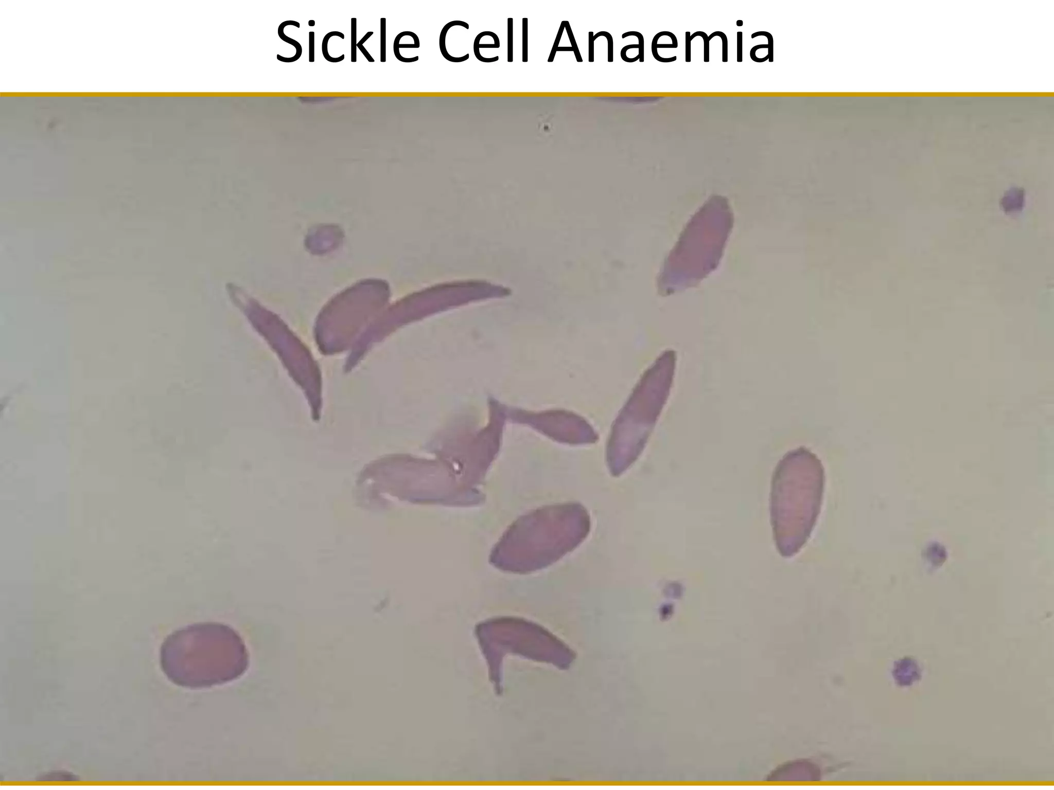 Sickle Cell Anaemia
 