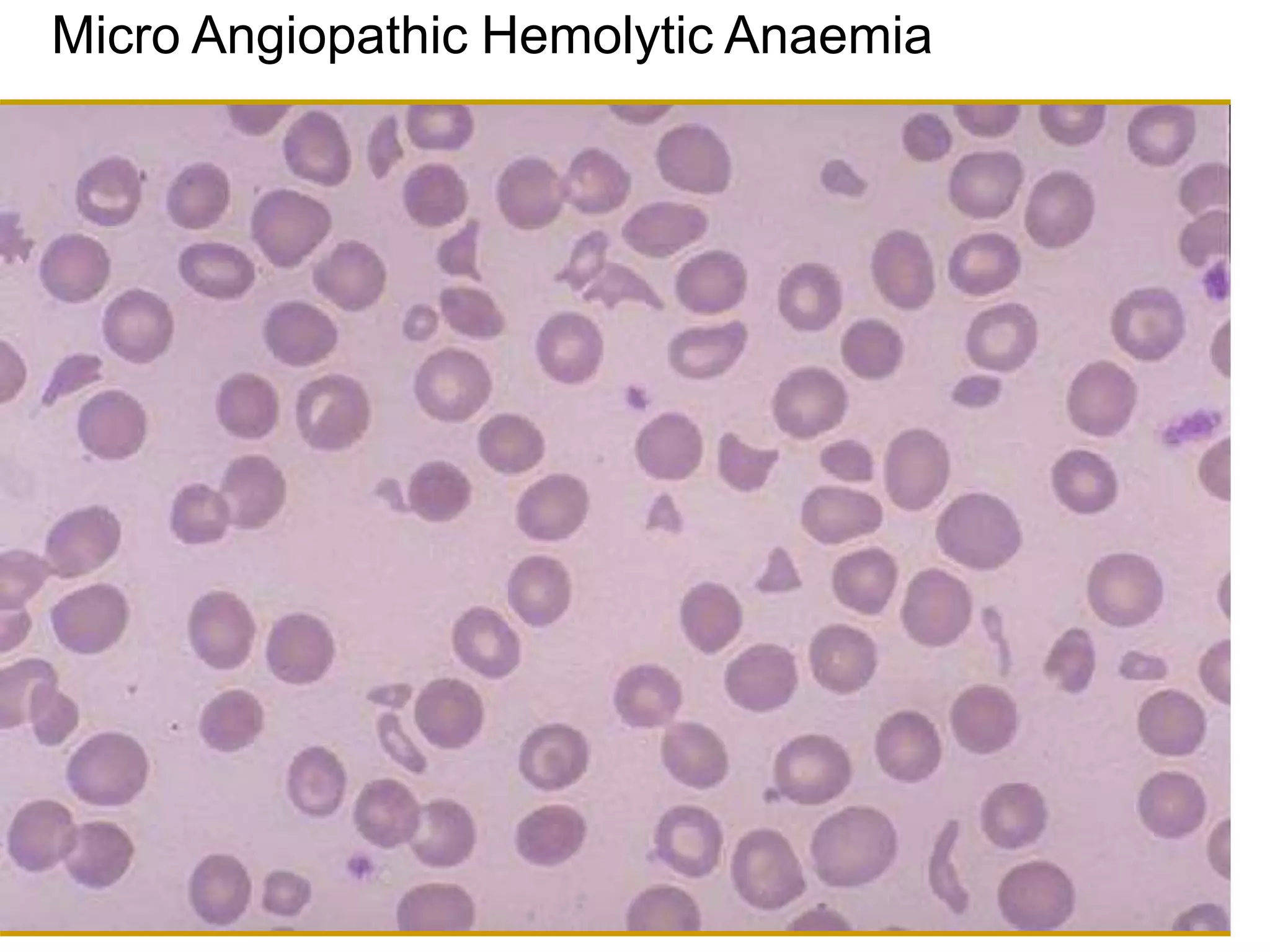 Micro Angiopathic Hemolytic Anaemia
 
