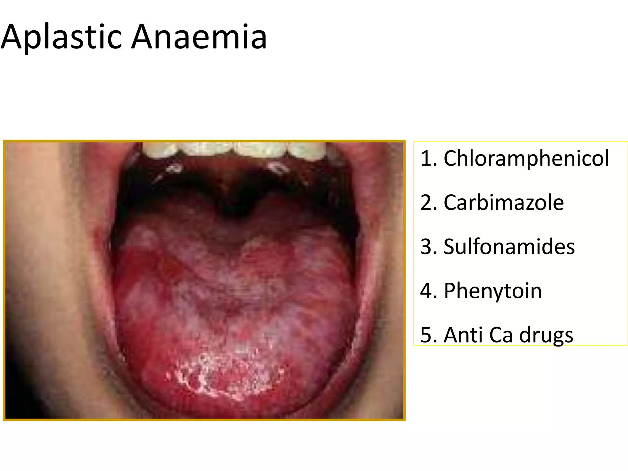 Aplastic Anaemia
1. Chloramphenicol
2. Carbimazole
3. Sulfonamides
4. Phenytoin
5. Anti Ca drugs
 