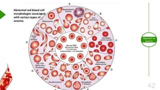42
Approach to
Anemia
 
