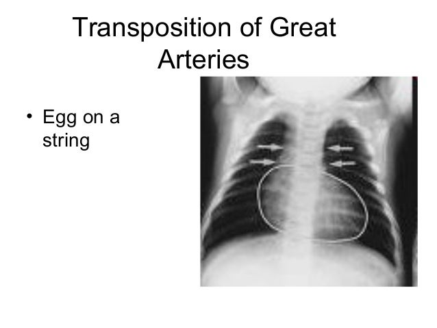 Transposition Of The Great Arteries X Ray Clipart 43 Stunning