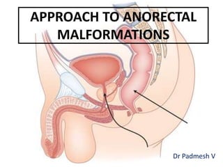APPROACH TO ANORECTAL
MALFORMATIONS
Dr Padmesh V
 