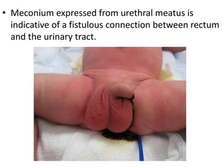 • Meconium expressed from urethral meatus is
indicative of a fistulous connection between rectum
and the urinary tract.
 