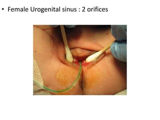 • Female Urogenital sinus : 2 orifices
 