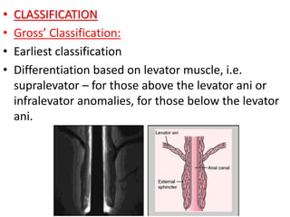 • CLASSIFICATION
• Gross’ Classification:
• Earliest classification
• Differentiation based on levator muscle, i.e.
supralevator – for those above the levator ani or
infralevator anomalies, for those below the levator
ani.
 