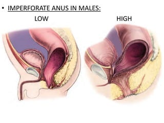 • IMPERFORATE ANUS IN MALES:
LOW HIGH
 