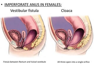 • IMPERFORATE ANUS IN FEMALES:
Vestibular fistula Cloaca
Fistula between Rectum and Vulval vestibule All three open into a single orifice
 