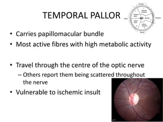 TEMPORAL PALLOR
• Carries papillomacular bundle
• Most active fibres with high metabolic activity
• Travel through the centre of the optic nerve
– Others report them being scattered throughout
the nerve
• Vulnerable to ischemic insult
 