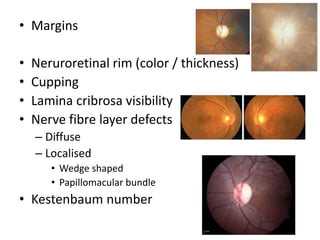 • Margins
• Neruroretinal rim (color / thickness)
• Cupping
• Lamina cribrosa visibility
• Nerve fibre layer defects
– Diffuse
– Localised
• Wedge shaped
• Papillomacular bundle
• Kestenbaum number
 