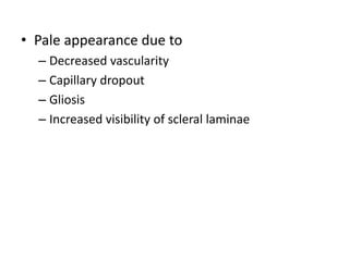 • Pale appearance due to
– Decreased vascularity
– Capillary dropout
– Gliosis
– Increased visibility of scleral laminae
 