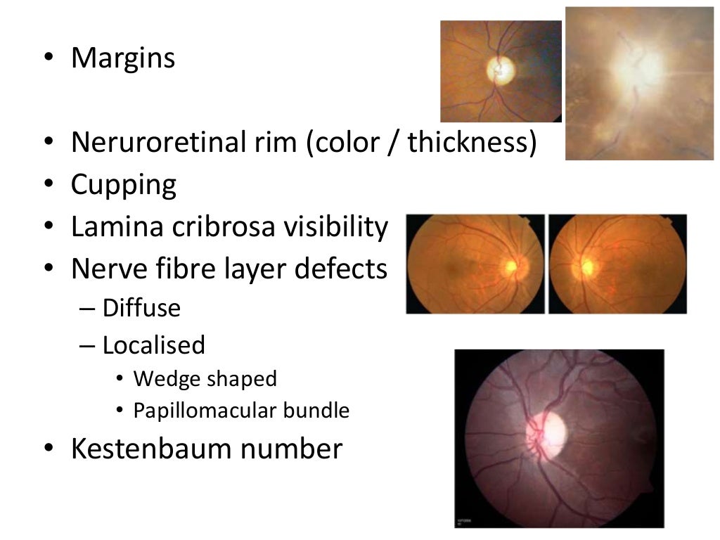 Approach to a pale optic disc