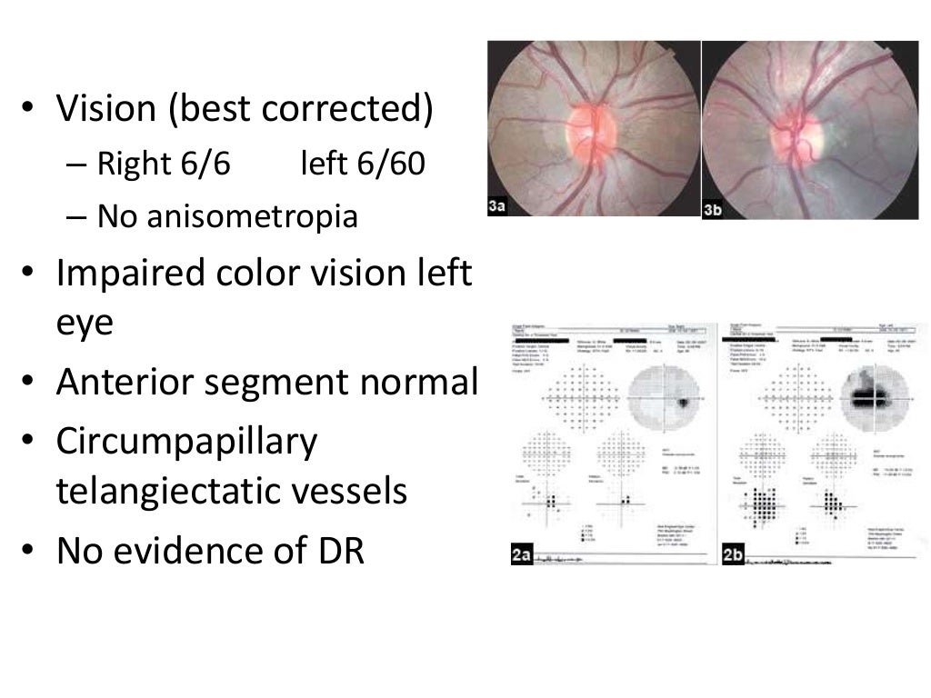 Approach to a pale optic disc