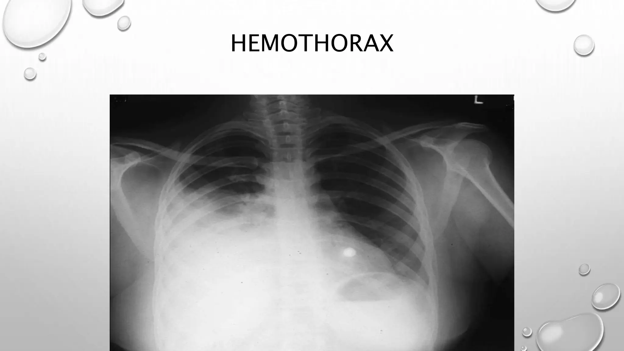 Chest Fragmentation Injuries Approach to a patient of chest injury.pptx