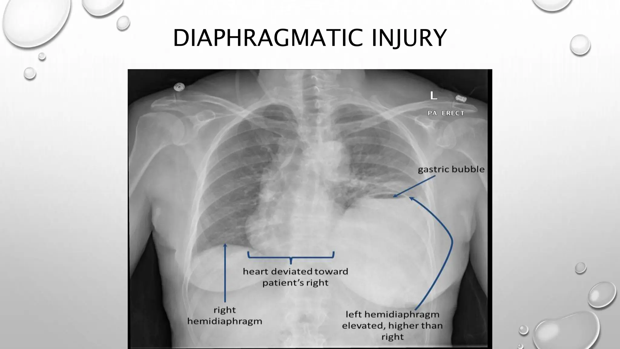 Chest Fragmentation Injuries Approach to a patient of chest injury.pptx