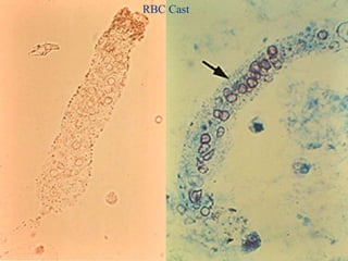 Stool Rbc Cast Approach to a patient with active urinary sediments | PPTX