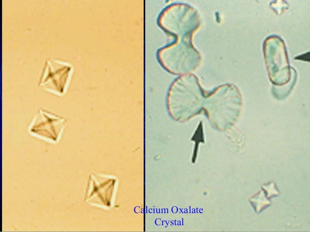 Approach to a patient with active urinary sediments