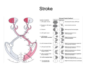 Half Vision Approach to a patient with bilateral vision loss | PPTX