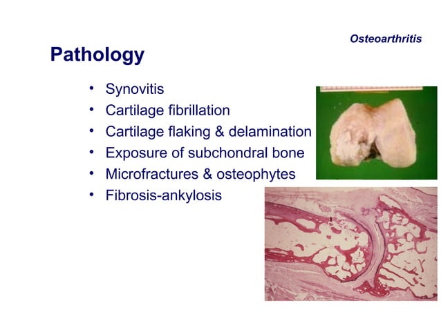 Approach To A Patient With Polyarthritis