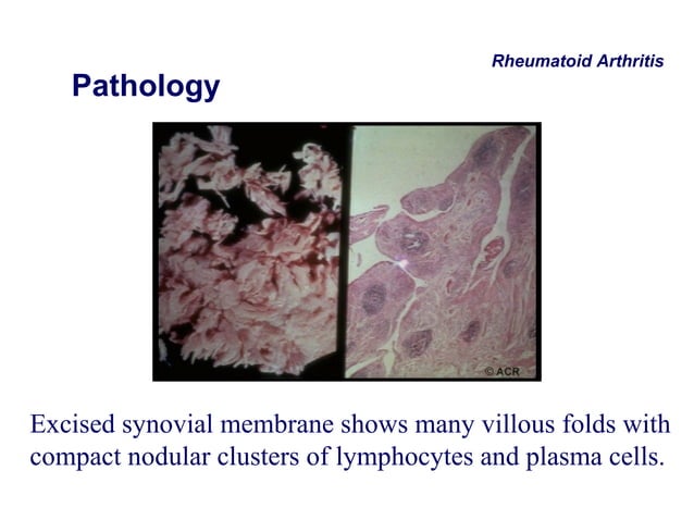 Approach To A Patient With Polyarthritis