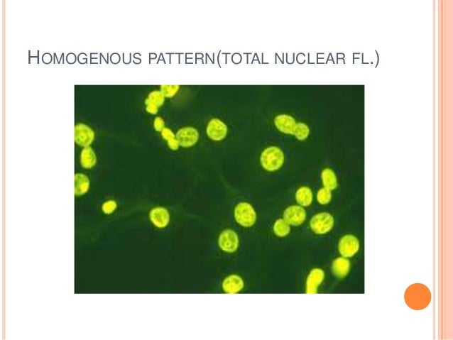 Approach To A Patient With Positive Ana Levels 40 Cool Speckled Pattern Ana Approach To A Patient With Positive Ana Levels 40 Cool Speckled Pattern Ana