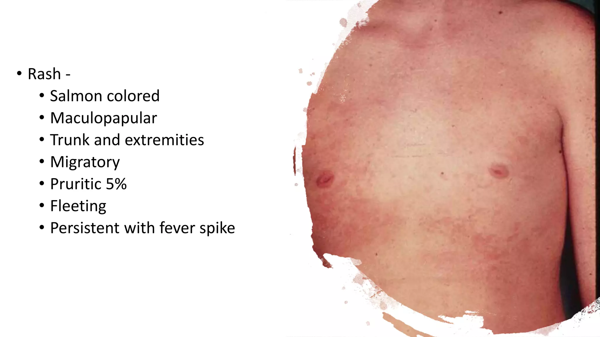 Approach to arhritis in children | PPTX