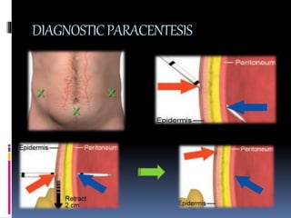 Ascites Sampling Approach to ascites | PPTX