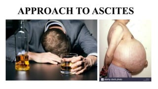 APPROACH TO ASCITES
 