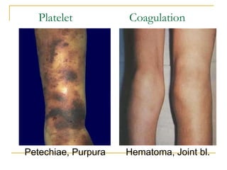Platelet Coagulation Petechiae, Purpura   Hematoma, Joint bl. 